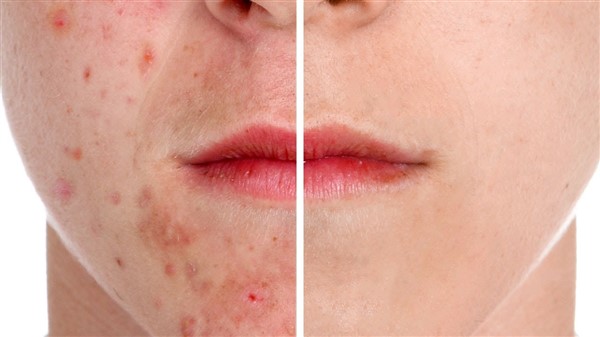 trattamento per acne