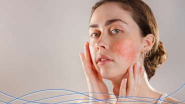 Rosacea