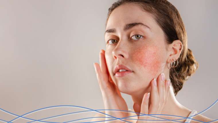 Rosacea