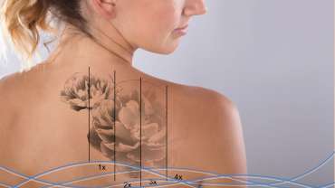 Rimozione Tatuaggi