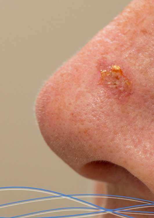 trattamento delle cheratosi attiniche Soluzioni per il trattamento delle cheratosi attiniche